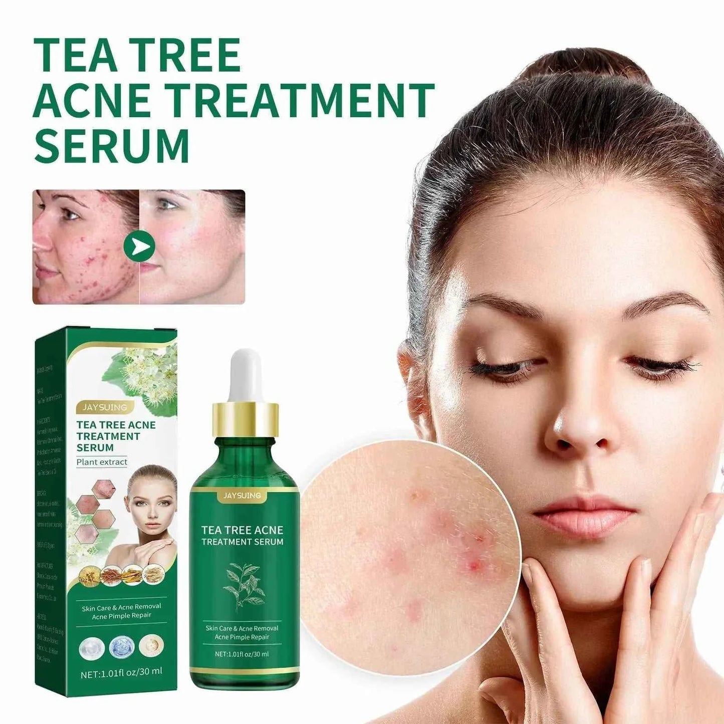 Tea Tree Oil Acne essence Attenuates Acne Print Facial fastdrop shop