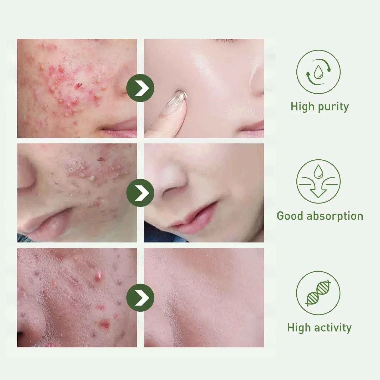 Tea Tree Oil Acne essence Attenuates Acne Print Facial fastdrop shop