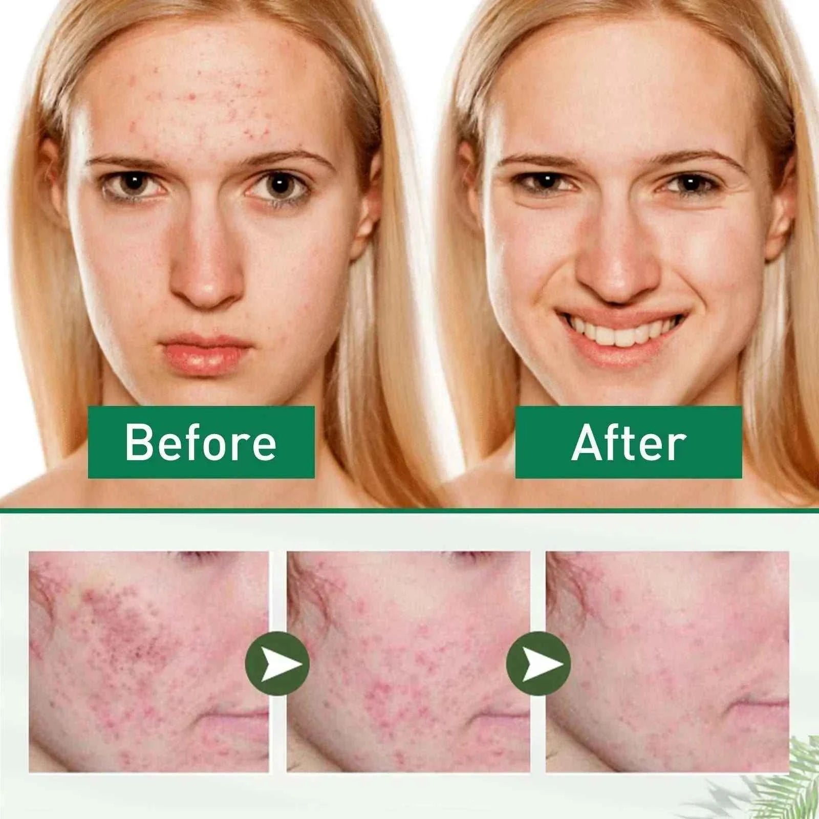 Tea Tree Oil Acne essence Attenuates Acne Print Facial fastdrop shop